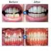 Picture of Orthodontic Appliance Silicone Simulation Braces Anti-molar Braces for Night (The second stage)